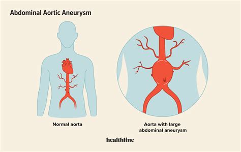 An <b>abdominal</b> <b>aortic</b> <b>aneurysm</b> occurs along the part of the aorta that passes through the abdomen. . Leaking abdominal aortic aneurysm symptoms